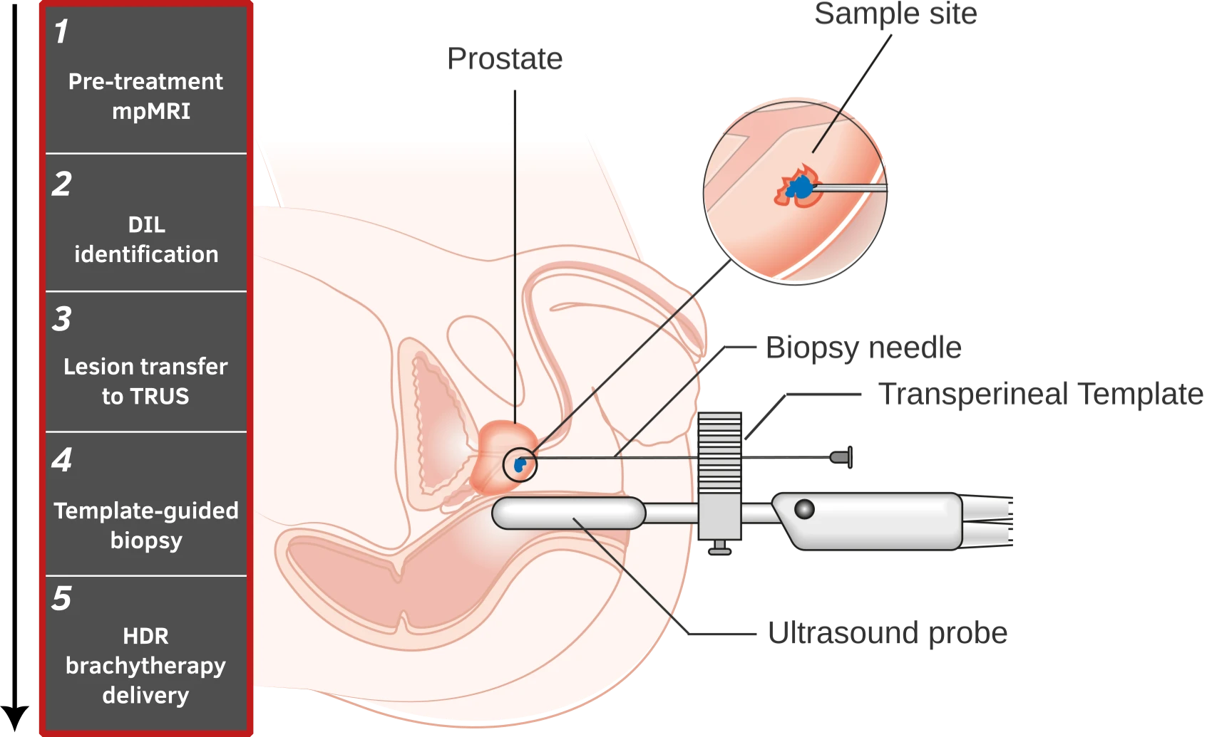 Clinical prostate biopsy workflow from MRI targets to ultrasound-guided sampling and HDR brachytherapy