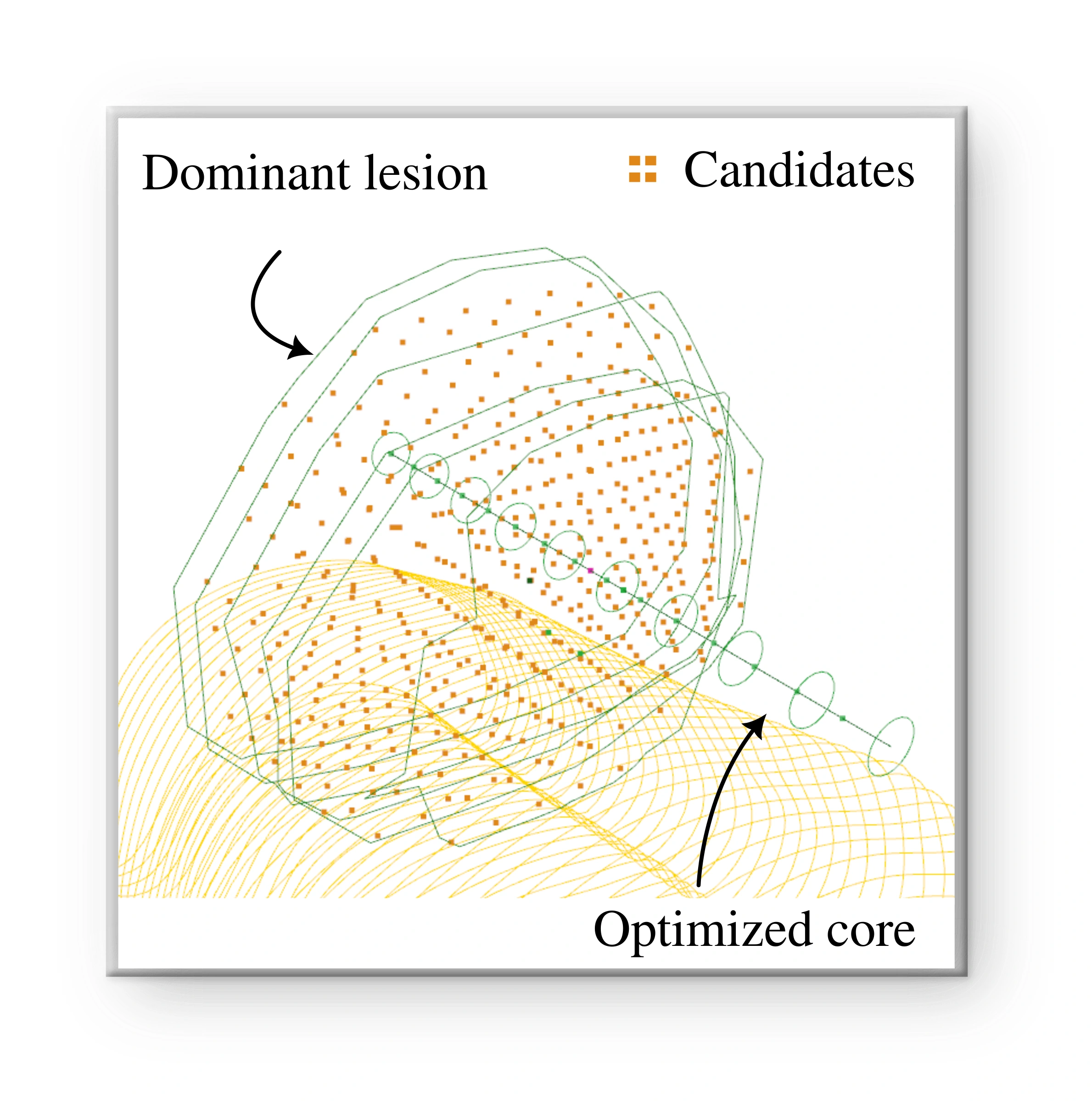 Candidate biopsy positions in orange around a labelled lesion, alongside the optimized core in 3D anatomy.