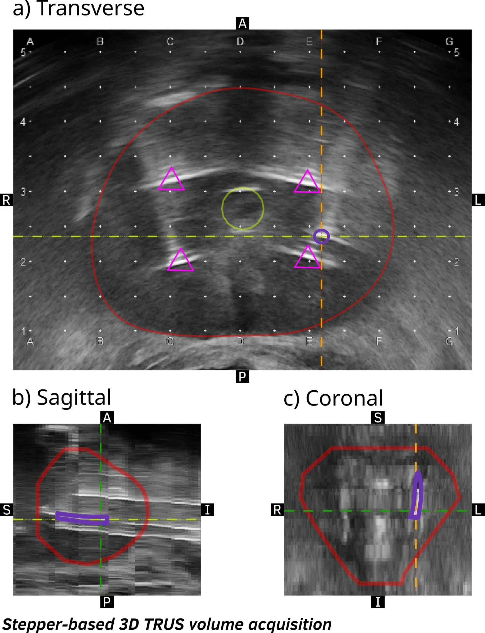 Transverse, sagittal and coronal ultrasound views with the reconstructed biopsy contour in purple